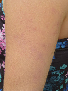 A photo of healed keratosis pilaris on an arm