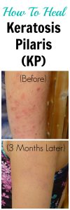 How to heal keratosis pilaris naturally. This post shares the products including creams, lotions, essential oils and scrub you can use to treat keratosis pilaris or chicken skin. These before and after photos show you how to get rid of keratosis pilaris. #keratosispilaris #treatment 