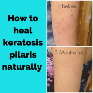 Arm with keratosis pilaris before and after treatment