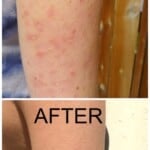 A before and after photo of an arm with keratosis pilaris with the title "how to treat keratosis pilaris" over it.