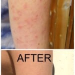 Before and after photos of an arm with keratosis pilaris with the title "how to heal keratosis pilaris" over it.
