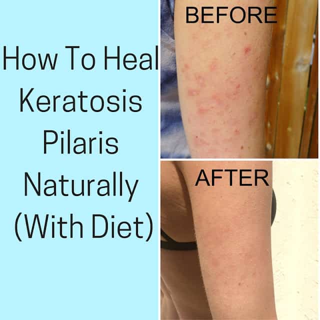 An image of before and after photos of keratosis pilaris, after treating it with diet