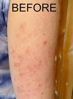 A before photo of keratosis pilaris on an arm