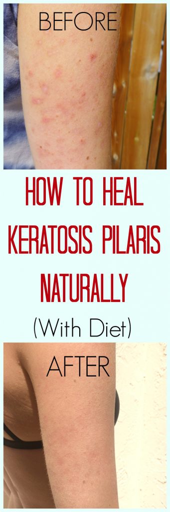 Keratosis pilaris, also known as chicken skin has many different causes. These before and after photos show you how to treat it naturally, or how to get rid of it with diet. Other natural remedies include scrubs, and essential oils. #keratosispilaris #KP #diet #naturalremedies