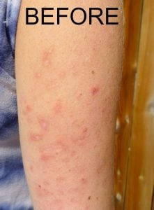 A photo of keratosis pilaris on an arm
