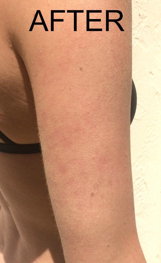 An after photo of keratosis pilaris on an arm. 