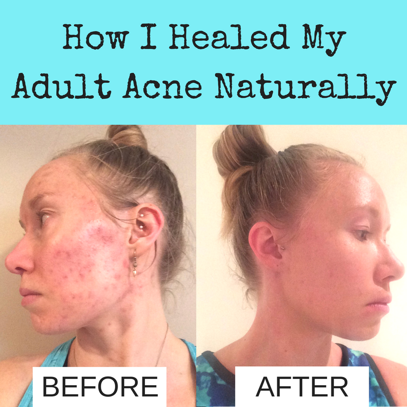  How I Healed My Acne Naturally 