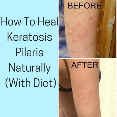  How To Heal Keratosis Naturally With Diet 