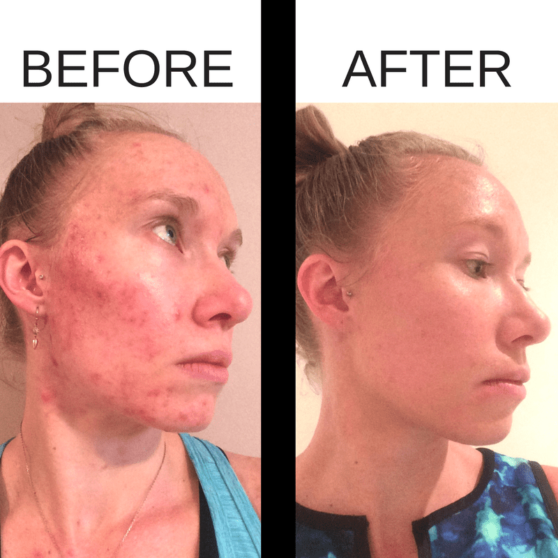 Before and after acne photos after using Beautycounter products. 