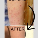 Before and after photos of a right arm, the before photo with keratosis pilaris on it, and the after photo without.
