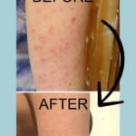 Before and after photos of an arm that had keratosis pilaris before and none after.