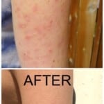 Before and after photos of an arm with keratitis pilaris with the title "how to treat keratosis pilaris with diet" over it.