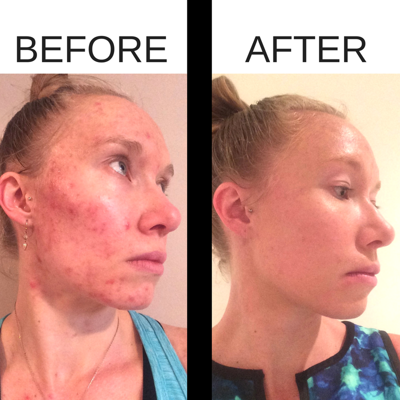 Before and after photos from using the Beautycounter charcoal mask for acne.