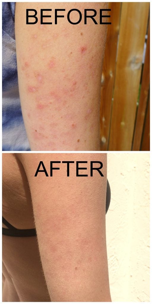 Before and after photos of arms with Keratosis Pilaris 