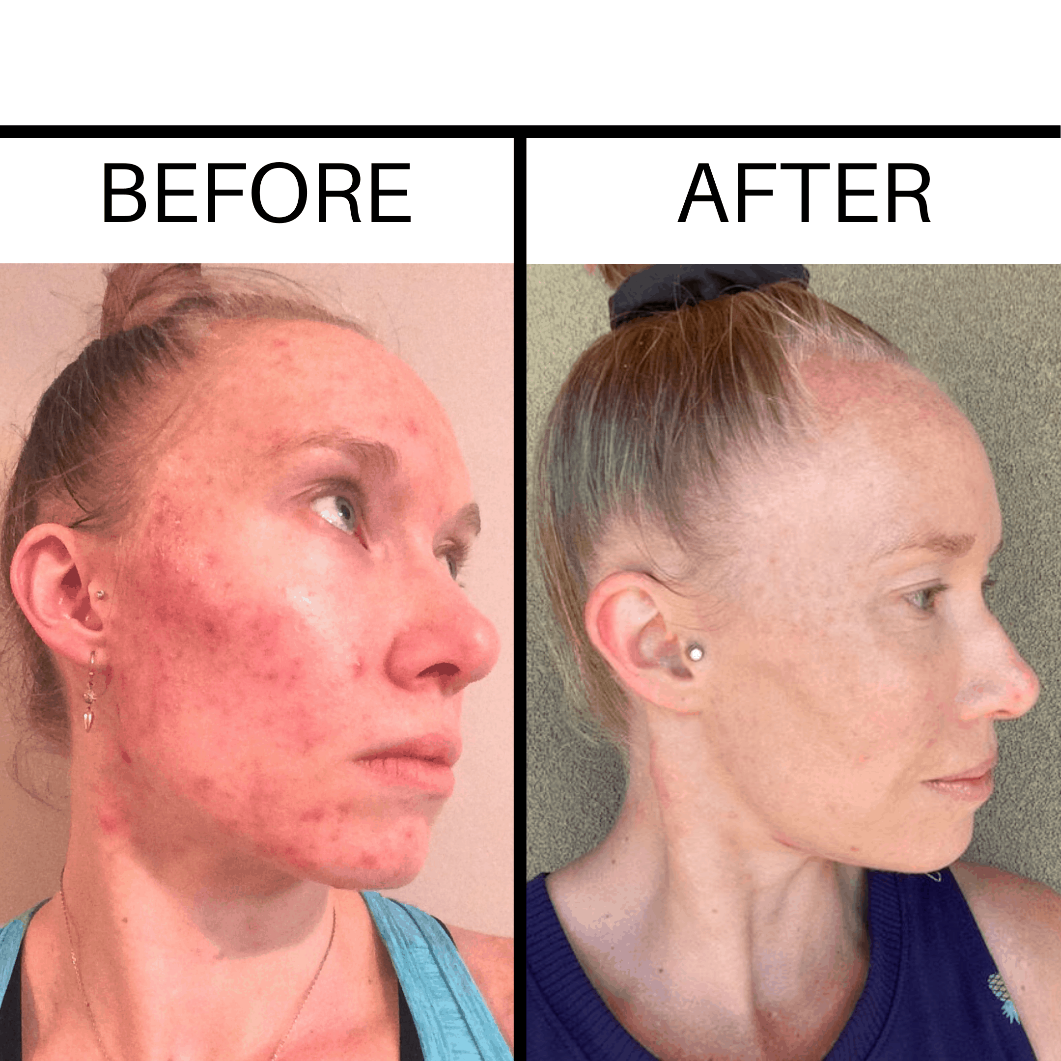 A girl with before and after photos of acne and then with clear skin after using the Beautycounter overnight resurfacing peel.