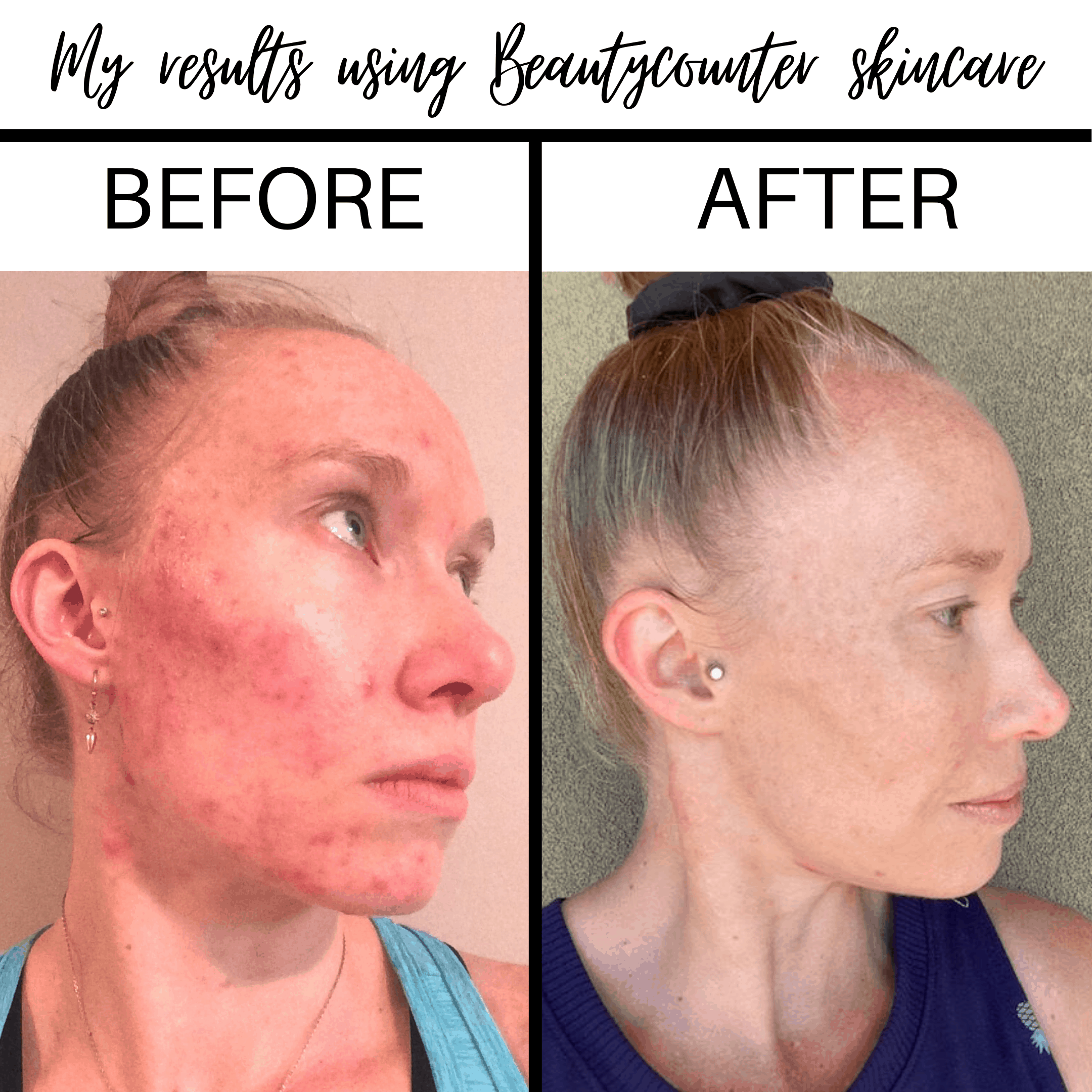 Before and after photos of using Beautycounter products for acne.