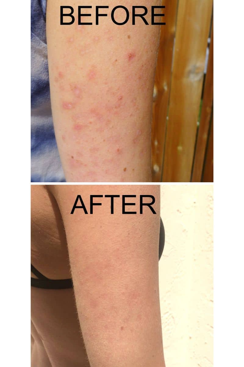 Before and after photos of an arm with keratosis pilaris that has been treated.