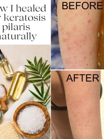 An arm with before and after photos of keratosis pilaris with the title "How I healed my keratosis pilaris naturally" beside it.