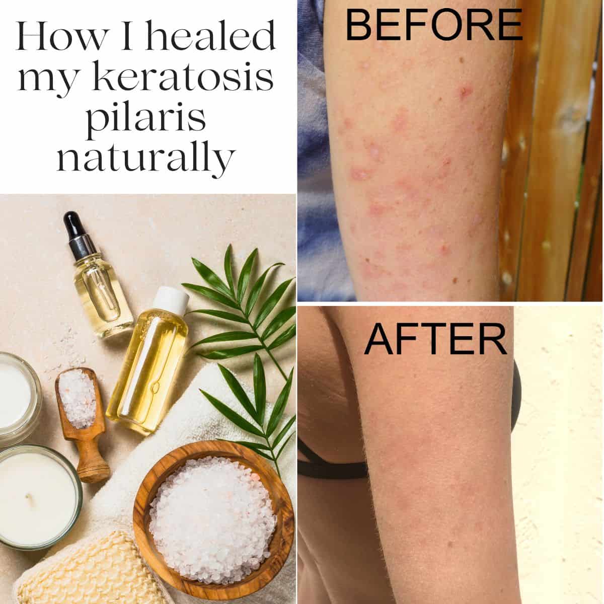 An arm with before and after photos of keratosis pilaris with the title "How I healed my keratosis pilaris naturally" beside it.