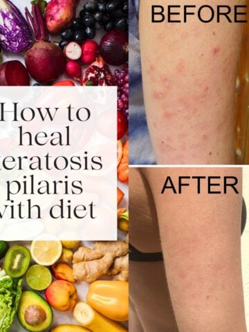 A before and after photo of keratosis pilaris with the title "how to heal keratosis pilaris with diet" over it.