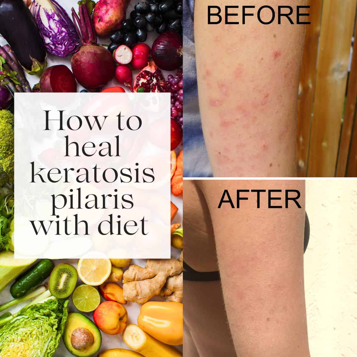 A before and after photo of keratosis pilaris with the title "how to heal keratosis pilaris with diet" over it.